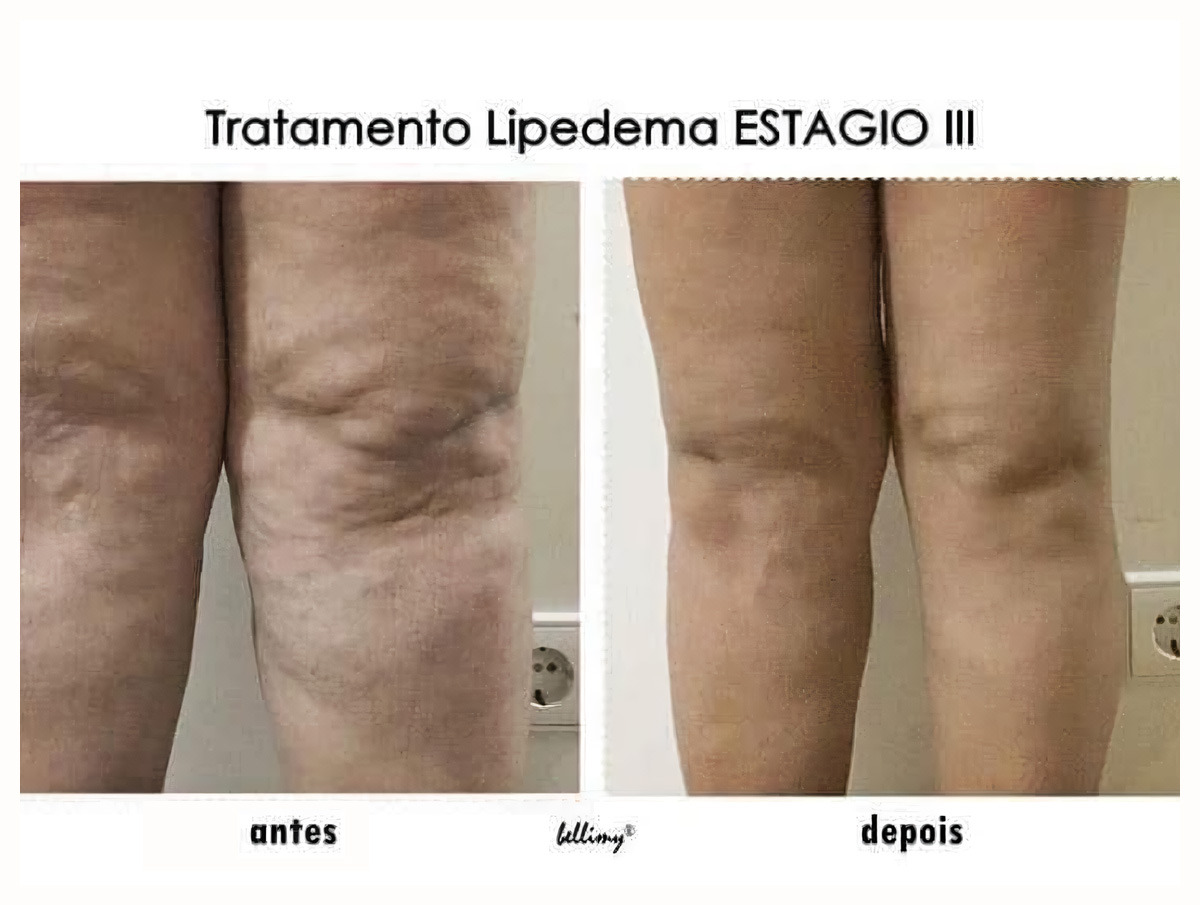Tratamento Lipedema